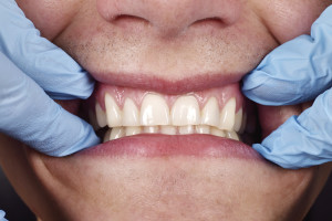 Dentist shows a patient's teeth, close up