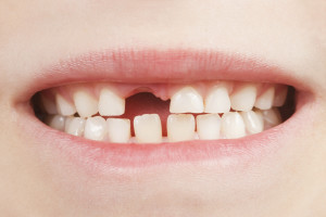 Closeup of the opened mouth of a child with a tooth space