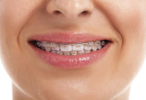 womans smiling showing white teeth with braces