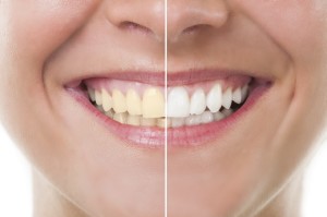 Before and after whitening