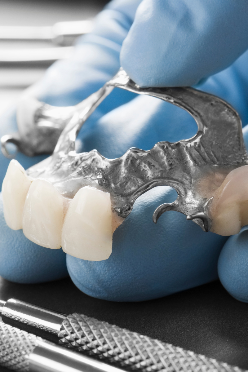 Dental Bridge Can Keep Your Teeth Healthier