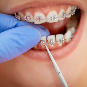 New Braces? Here’s How to Get Used to Them