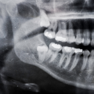 Why Do We Have Wisdom Teeth?