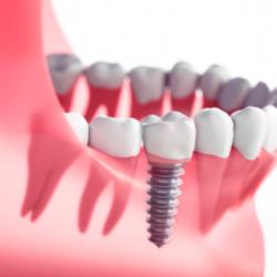 A Comprehensive Guide to Dental Implants at Holman Family Dentistry