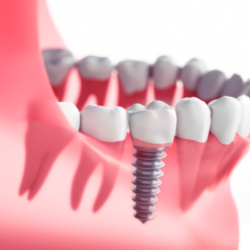 Benefits of Dental Implants