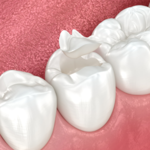 Everything You Need to Know About Fillings