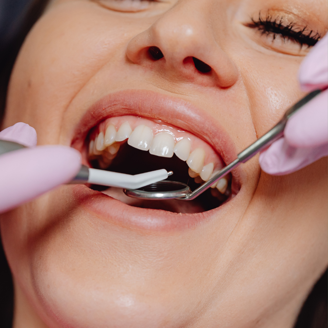 Rebuild Your Smile with Crowns and Bridges That Feel Like You