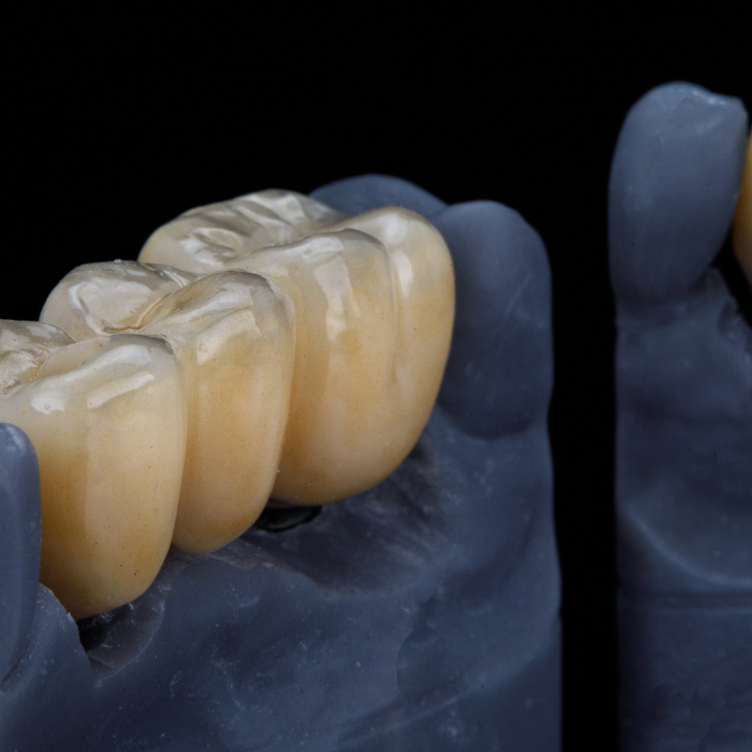 What’s the Difference Between Crowns and Bridges?