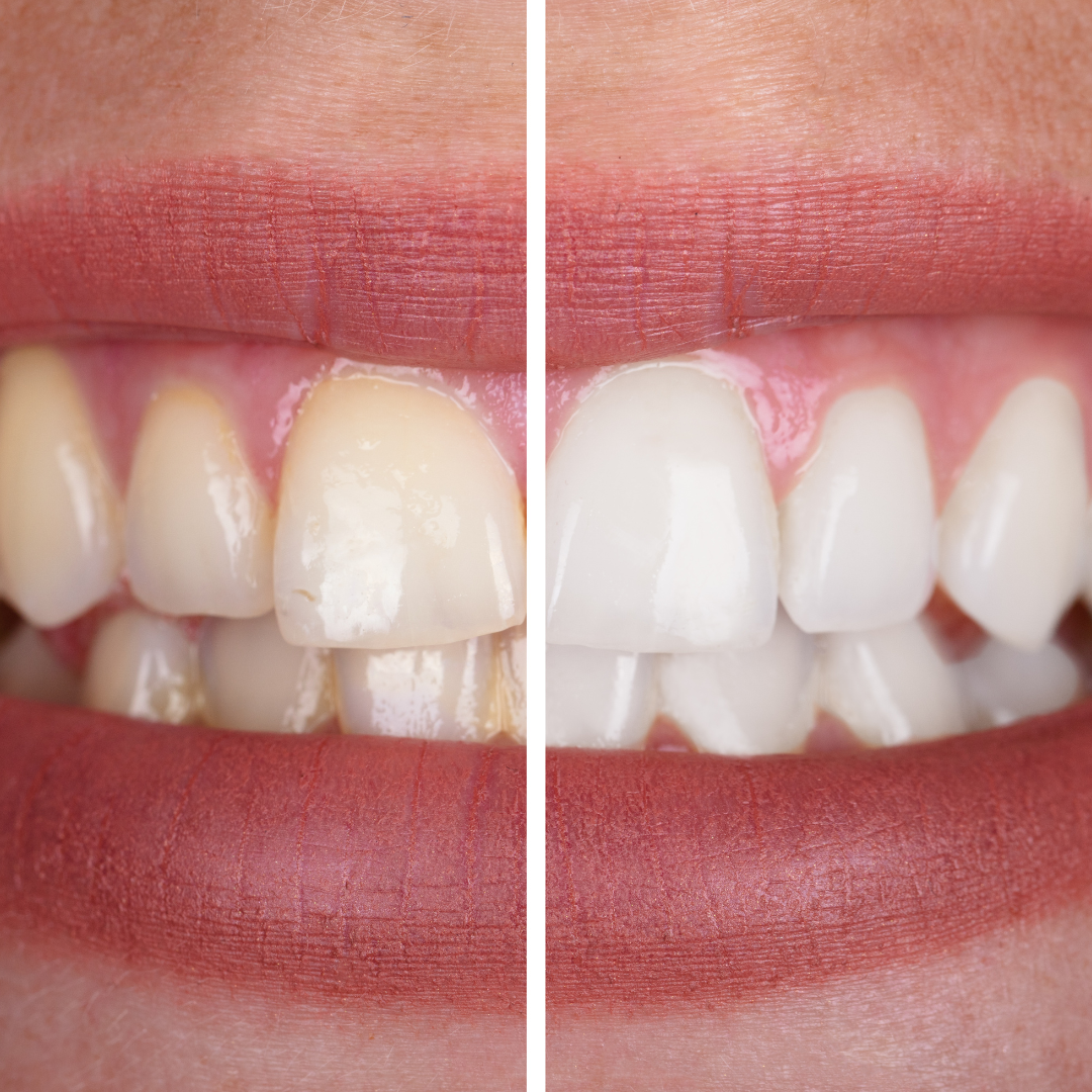 Teeth Whitening at the Dentist vs. At-Home Kits: What’s the Difference?