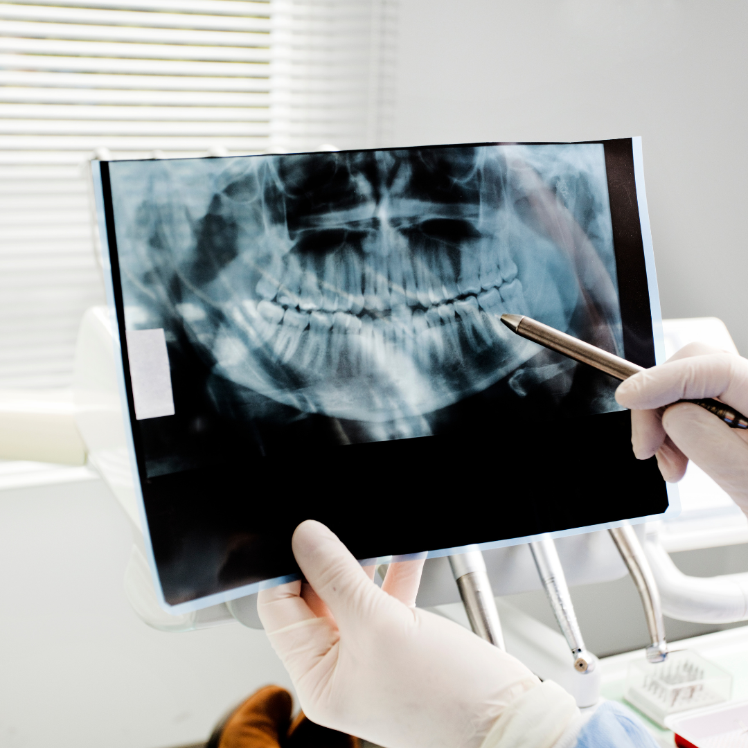 Dental X-Rays: Are They Safe and Why Are They Important?