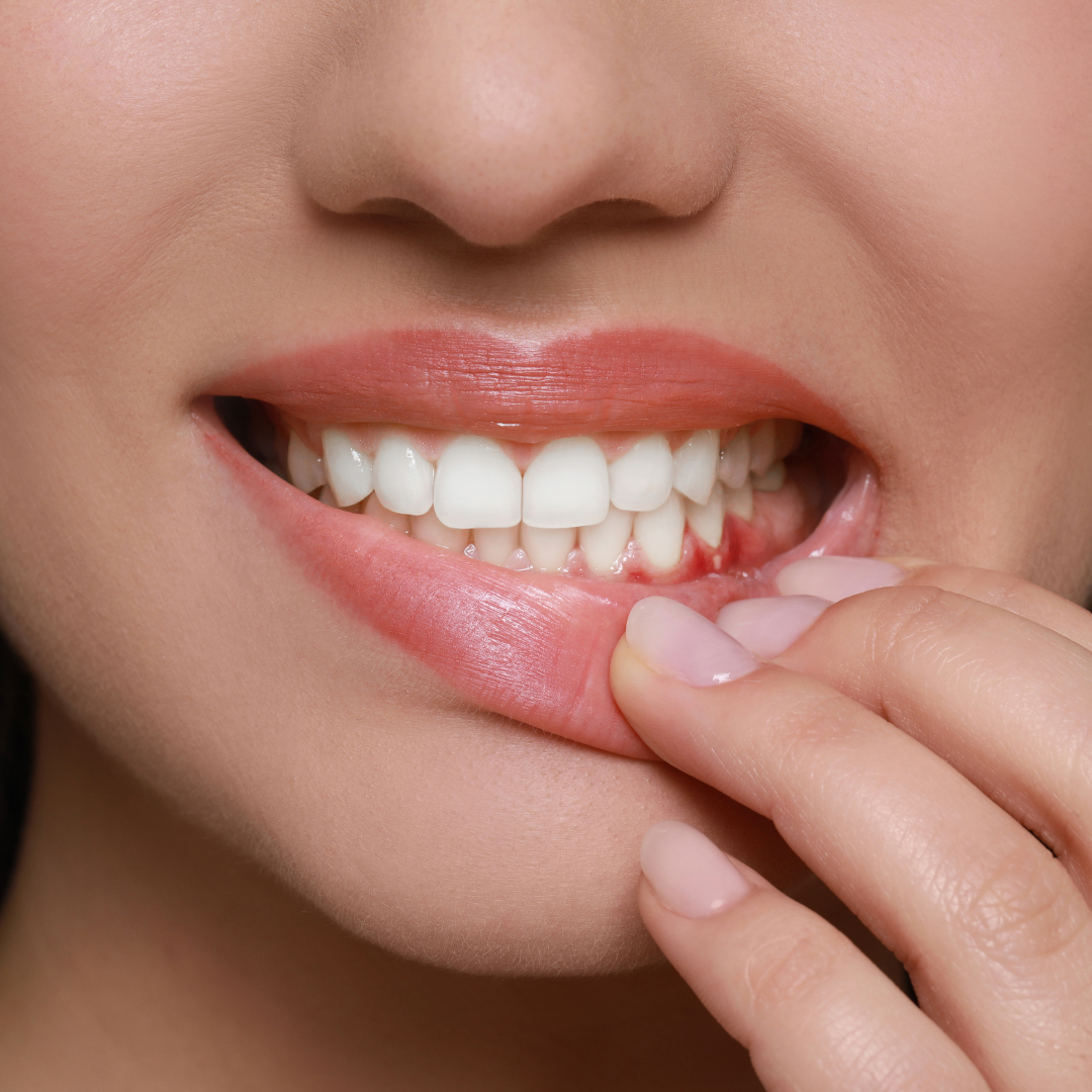What Happens If You Ignore Bleeding Gums for Too Long?