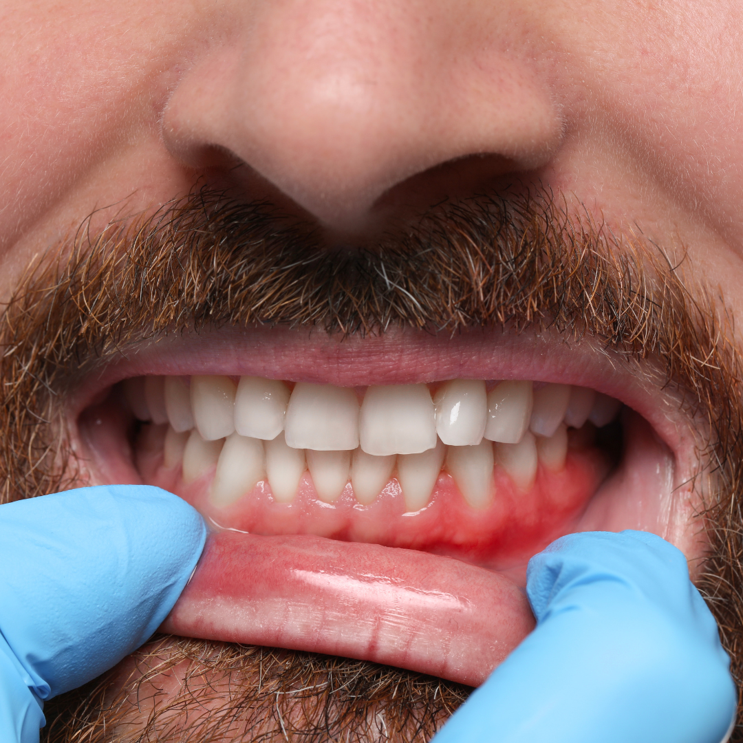 Why Your Gums May Feel More Sensitive in Hot Weather
