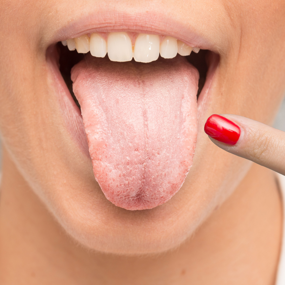 What Your Tongue Can Tell You About Your Oral Health
